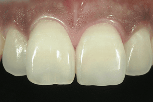 折れた前歯：削らずに理想的な歯の形に修正する場合2