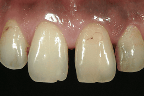 前歯の隙間：削らずに理想的な歯の形に修正する場合1