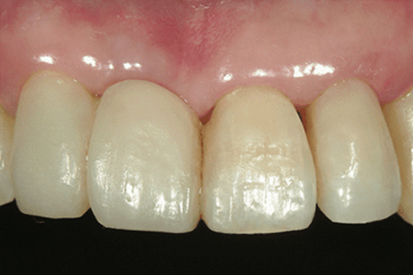 欠損した前歯：削らずに理想的な歯の形を構築する場合2
