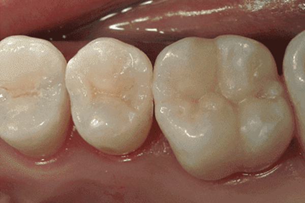【咬む面】のみの銀歯(虫歯)→ダイレクトボンディング修復2-2