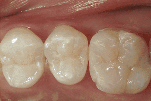 【隣の歯との間】を含む銀歯→ダイレクトボンディング修復2