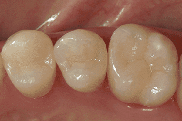 【隣の歯との間】を含む銀歯→ダイレクトボンディング修復2-2