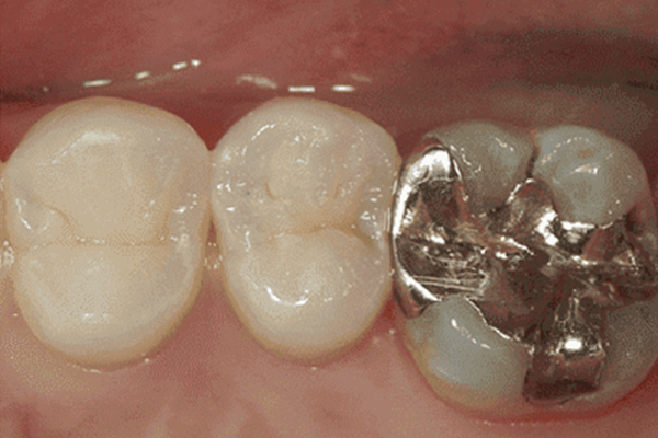 【隣の歯との間】を含む銀歯→ダイレクトボンディング修復1