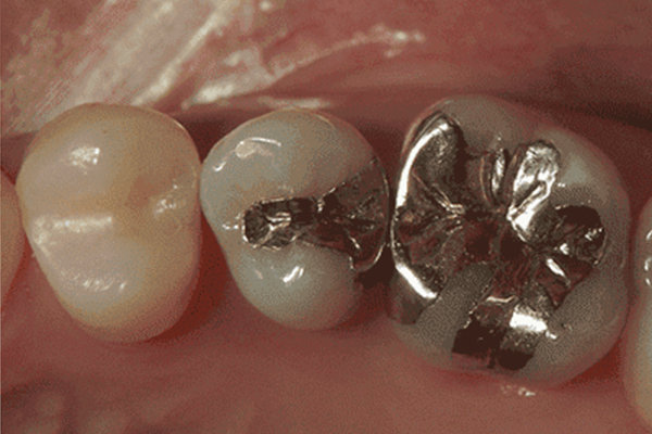 【隣の歯との間】を含む銀歯→ダイレクトボンディング修復1-1